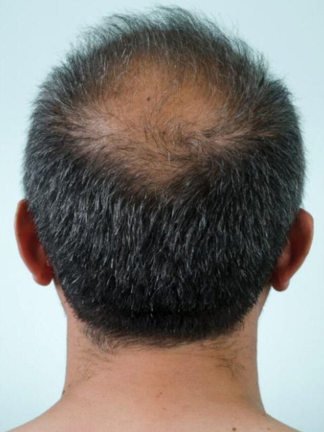 এই ৫ খাবার ঝরিয়ে দেয় চুল, অকালেই পড়বে টাক