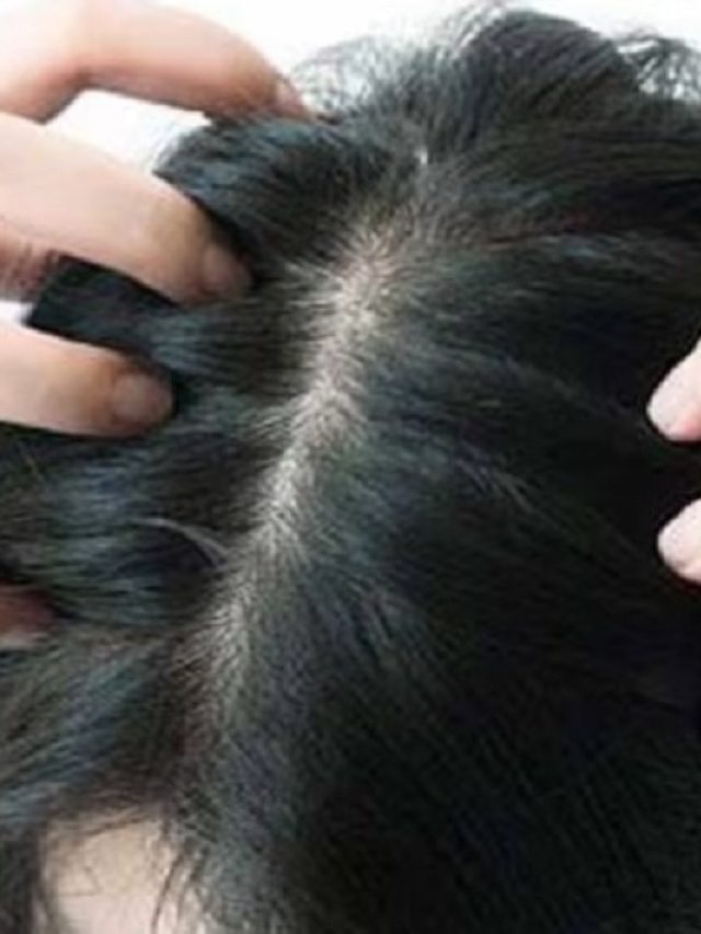 ওষুধে ক্ষতি হয় চুলের, এই তেলেই চিরতরে নির্বংশ হবে মাথার উকুন