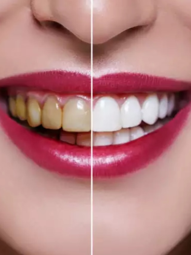 মুক্তোর মতো হবে হলুদ দাঁত, এই ট্রিকসেই করুন কামাল