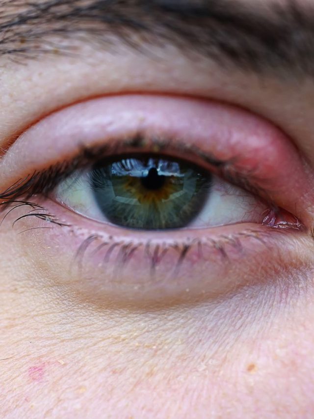 চোখে অঞ্জনির জন্য রইল ধন্বন্তরি টোটকা!