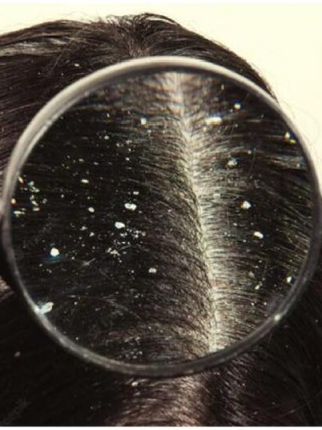 এই শীতে আর খুশকি ভোগাবে না, এভাবে বানান অ্যালোভেরার হেয়ার প্যাক