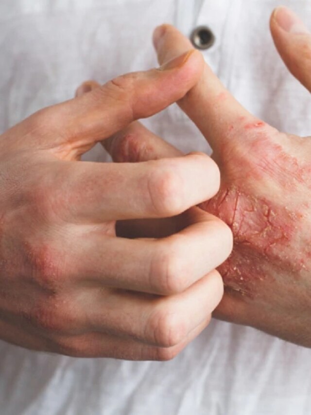 শরীরে র‍্যাশ-চুলকানি? রাসায়নিক ক্রিম নয়, ৫ ঘরোয়া টোটকায় মুক্তি