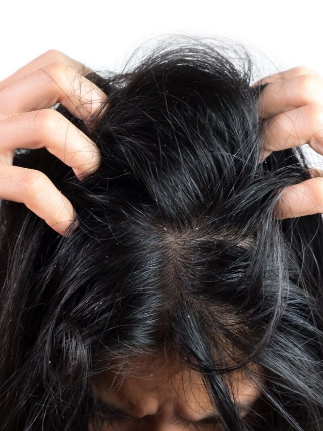 খুশকিতে জেরবার? ৭ দিনে দূর করার ঘরোয়া টিপস