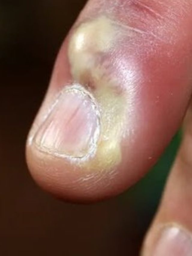 নখকুনিতে কষ্ট পাচ্ছেন? রইল সারানোর ৫ ঘরোয়া উপায়