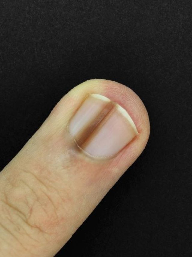 নখে এমন দাগ? হতে পারে রোগের লক্ষণ