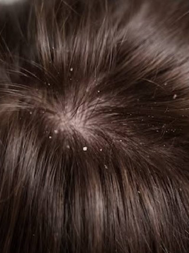 শীতকালে চুলে খুশকি বেশি হয়, কারণ জানলেই মিলবে মুক্তি