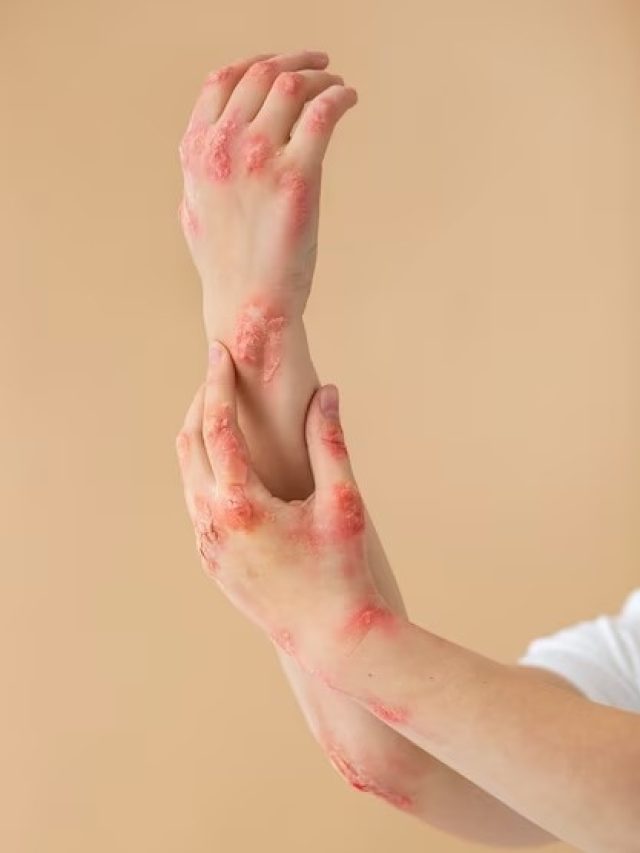 বাড়িতে বার্নল নেই? বাজিতে হাত পুড়লে ফোসকা এড়াতে যা করবেন