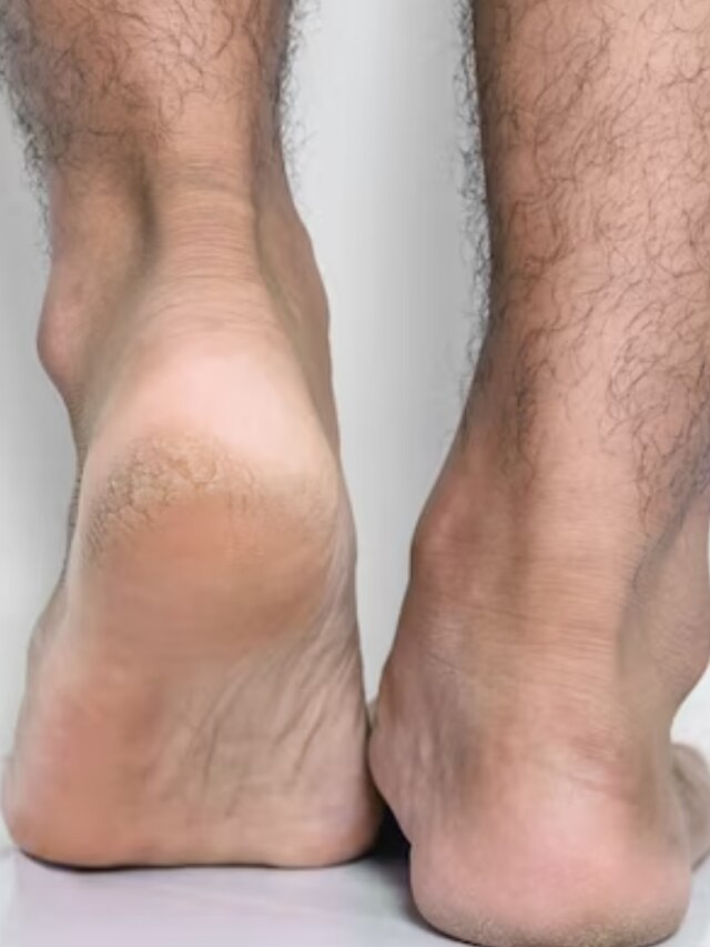 গরমেও পা ফাটছে? এই সাধারণ জিবিস লাগালেই হবে কাজ