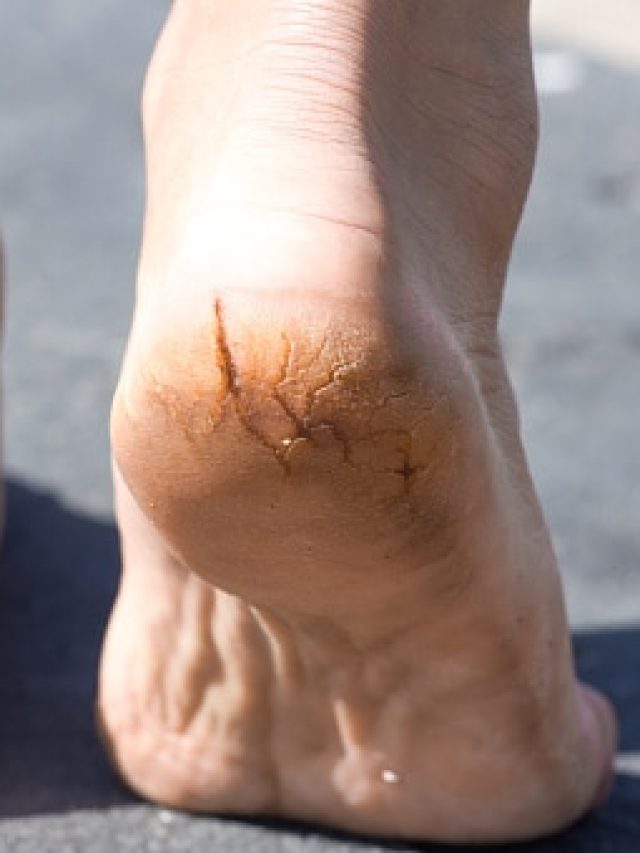 পা ফেটে রক্ত বেরোচ্ছে? ঘরোয়া প্রতিকারেই পা থাকবে কোমল