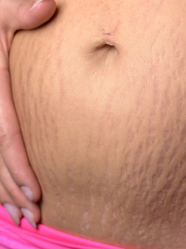 অলিভ অয়েল দিয়ে ঘরেই বানান এই পেস্ট, ১৫ দিনেই ছুমন্তর স্ট্রেচ মার্ক