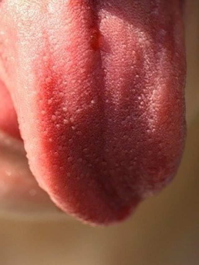 জিভে-ঠোঁটে ঘা ও জ্বালা ? এই গাছের পাতা চিবোলেই সারবে ১ দিনে