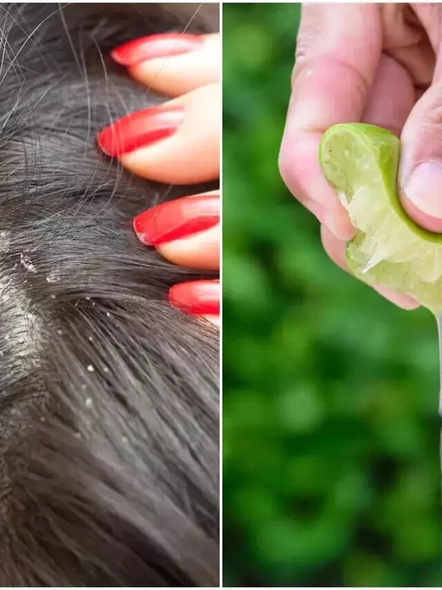 খুশকি থেকে রেহাই হপ্তা খানেকে, লেবু-নারকেল তেলের মোক্ষম ঘরোয়া টোটকা