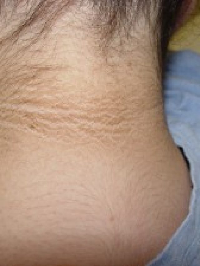 ঘাড় ও গলার কালচে দাগ কি কোনও রোগের উপসর্গ?