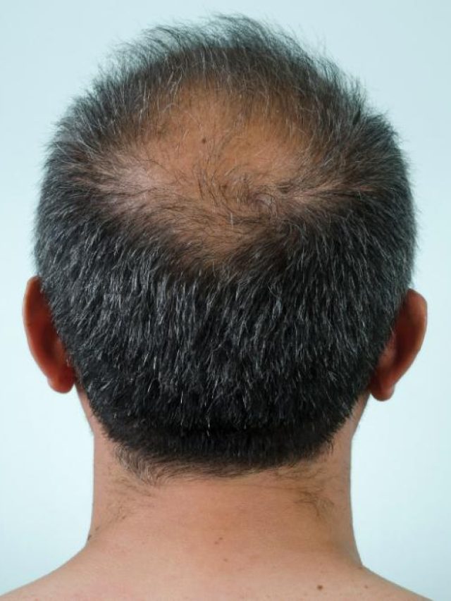 নাভিতে এই জিনিস ১ ফোঁটা, ফাঁকা টাকে গজাবে গুঁড়ি গুঁড়ি চুল