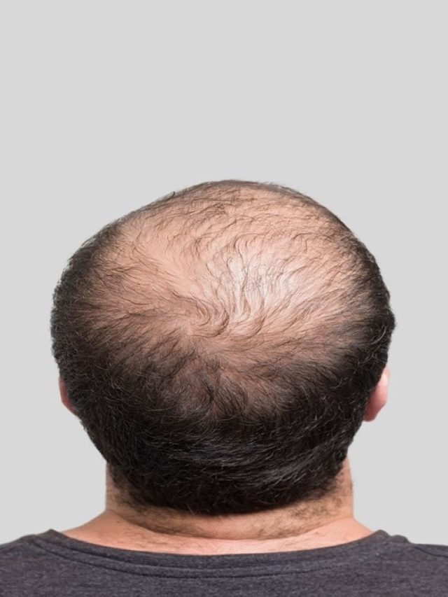 শ্যাম্পু করার আগে চুলে লাগান এটা, টাক ভরে উঠবে চুলে