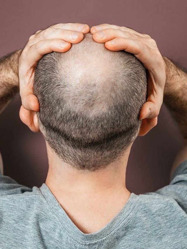 এটা ঘষলেই টেকো মাথায় গজাবে কুচো চুল, সস্তার হ্যাকস