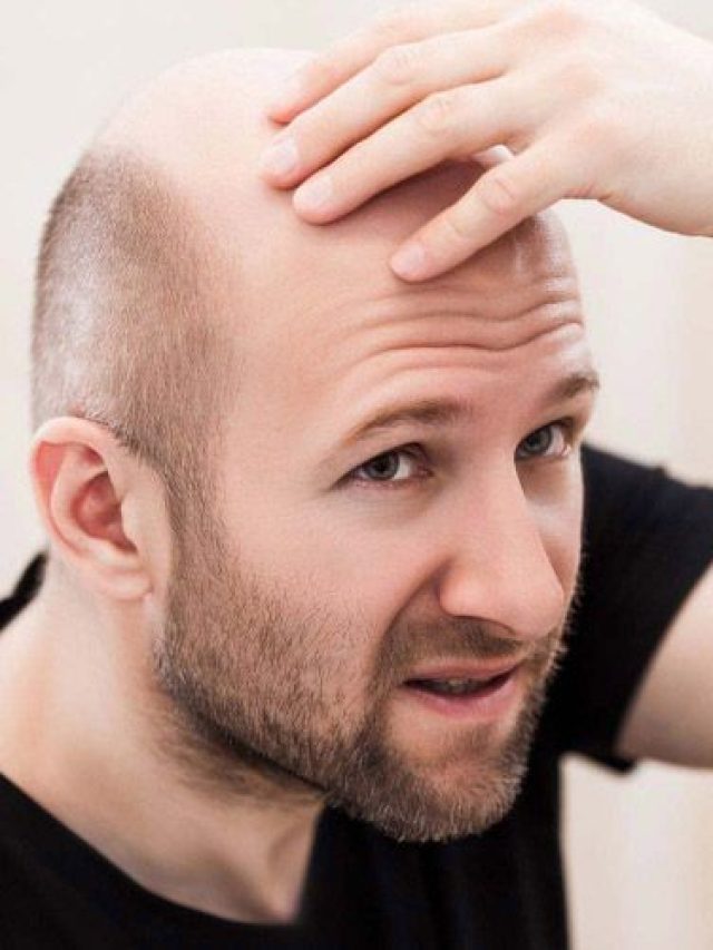 এইগুলো খাবারগুলো খেলে টাক  অবধারিত, কম বয়সে মাথা হবে ফাঁকা