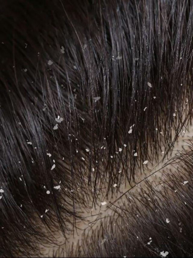 মাথায় খুব খুসকি? লেবু-তেলের এই টোটকায় কমবে