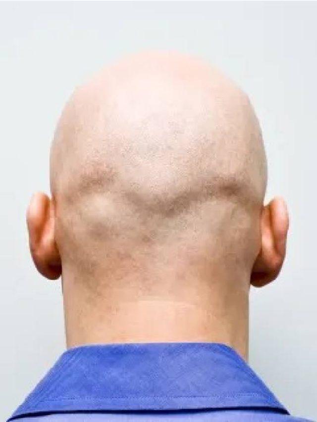 টাকে রাতারাতি চুল গজাবে, যদি এটা লাগান