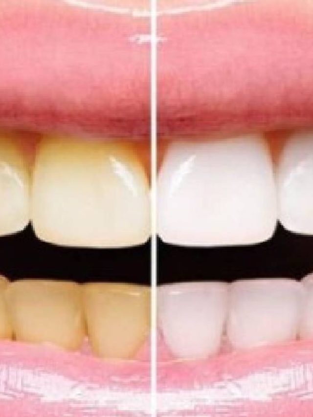 দাঁতে হলদে ছোপ? নুন, তেল দিলেই জেল্লা ফিরবে, কী ভাবে?