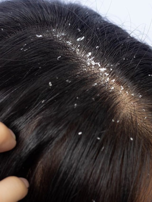 ৫ টাকার এই ফলের রসেই খুসকি গায়েব, আজই ট্রাই করে দেখুন