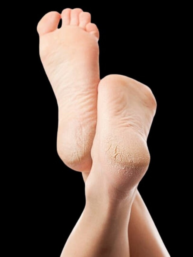 শীতে গোড়ালি ফেটে চৌচির? রইল সারানের সহজ ঘরোয়া উপায়