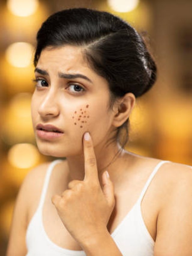 ব্রণর সমস্যা? লবঙ্গেই সমাধান