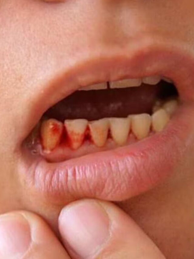 মাড়ি দিয়ে রক্তপাত, মুখে দুর্গন্ধ? এই ছোট্ট জিনিস চেবালেই মুক্তি