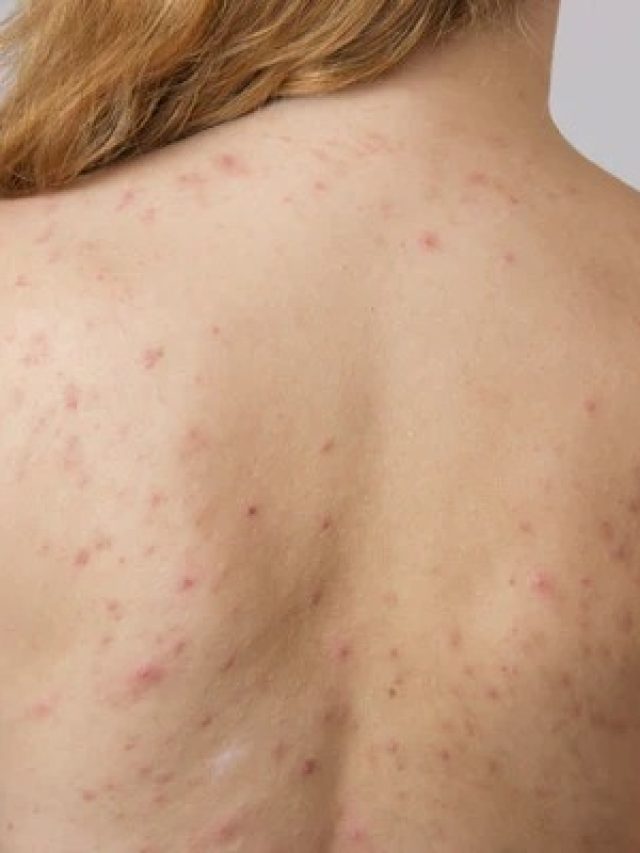 ব্রণ কেড়েছে পিঠের সৌন্দর্য? থাকল  মুক্তির অব্যর্থ ঘরোয়া ও সহজ উপায়