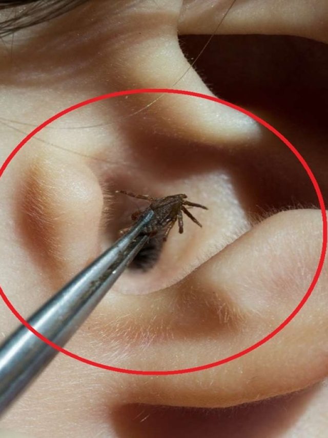 কানে হঠাৎ পোকা ঢুকলে কী করণীয়? জানা  জরুরি