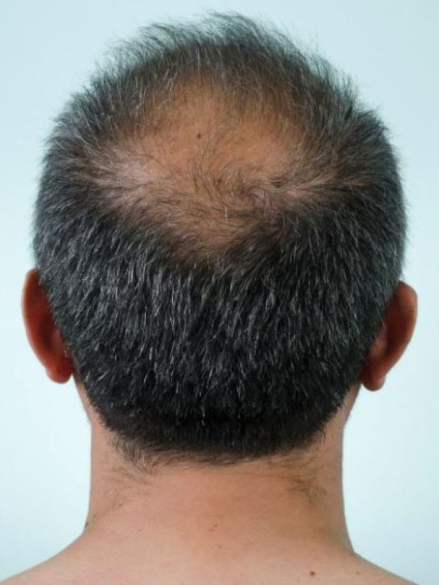 চুল পাতলা হয়ে যাচ্ছে? মোক্ষম নিয়মে মিলবে মুক্তি