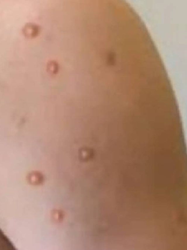 চিকেন পক্সের লক্ষণ কী কী? জেনে নিন