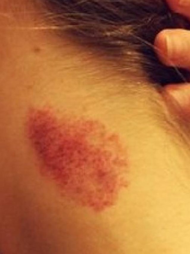 সঙ্গীর কামড়ে গলায় লভ বাইট? কীভাবে লুকোবেন দাগ, জানুন