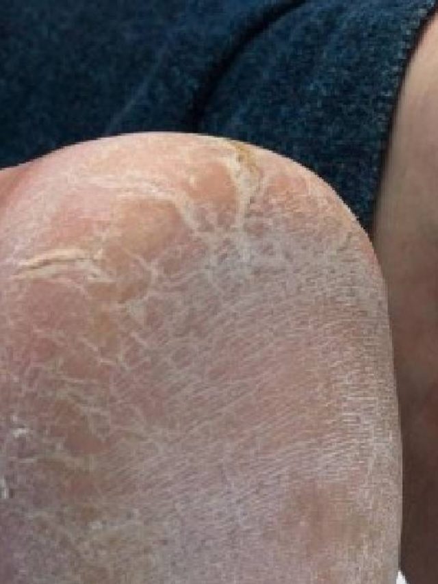 শীতে এটা লাগালেই  ফাটা গোড়ালি চকচক করবে