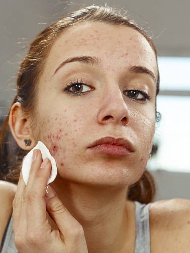 মুখে ব্রণ নিয়ে জেরবার? ঠাকুরমার এই প্রতিকারে নিমেষেই দূর হবে