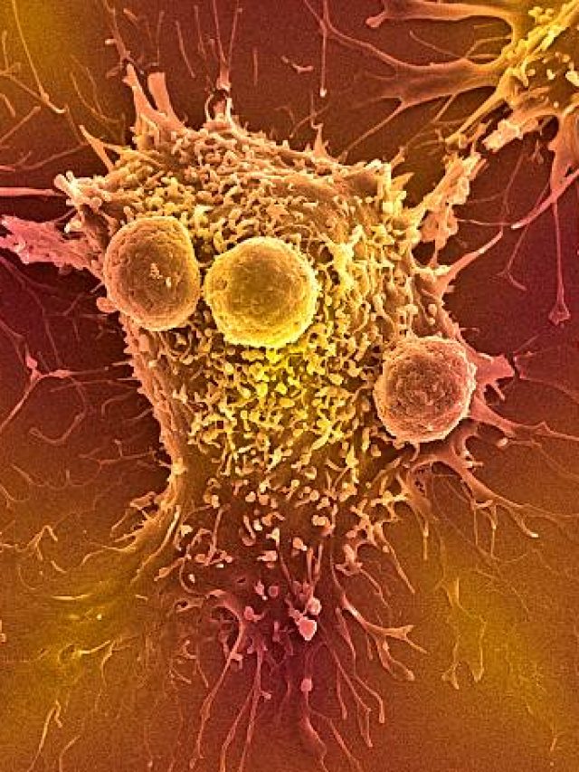 ক্যান্সার হলে শরীরে এই লক্ষণগুলো দেখা যায়, জেনে আগেই সতর্ক হোন