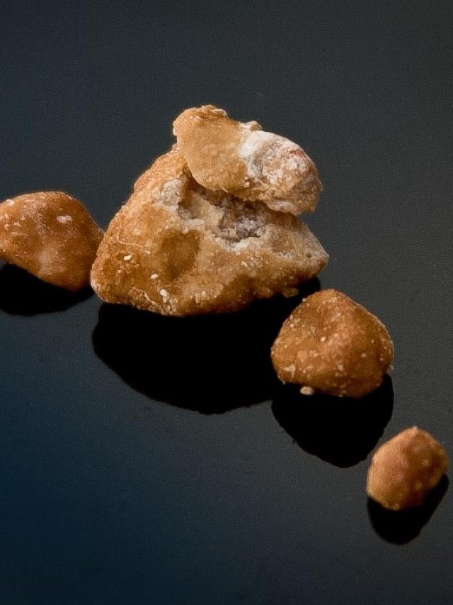 কিডনির কত বড় পাথর প্রস্রাব দিয়ে বেরিয়ে যায়? জরুরি তথ্য