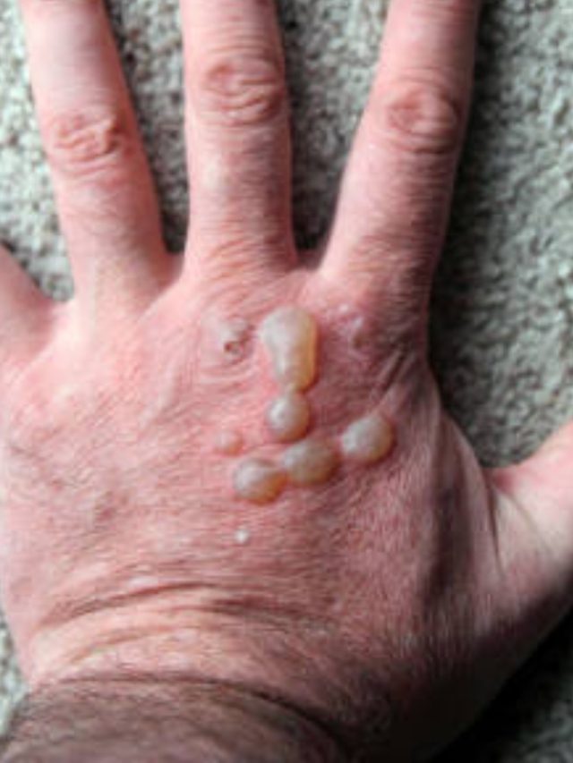 হাত পুড়েছে? এসব টোটকাতে জ্বালাপোড়া কমবে-ফোস্কাও পড়বে না