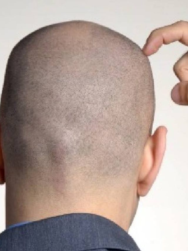 কালো চুল গজাবে,  দেখে হাসবে টাক,  এই ফুলের প্যাক  লাগালেই ম্যাজিক