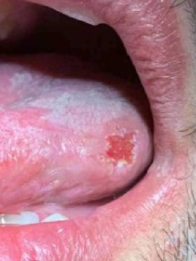 জিভে প্রায়ই ঘা হয়? ঘরের এই জিনিস দিয়েই সারান রোগ