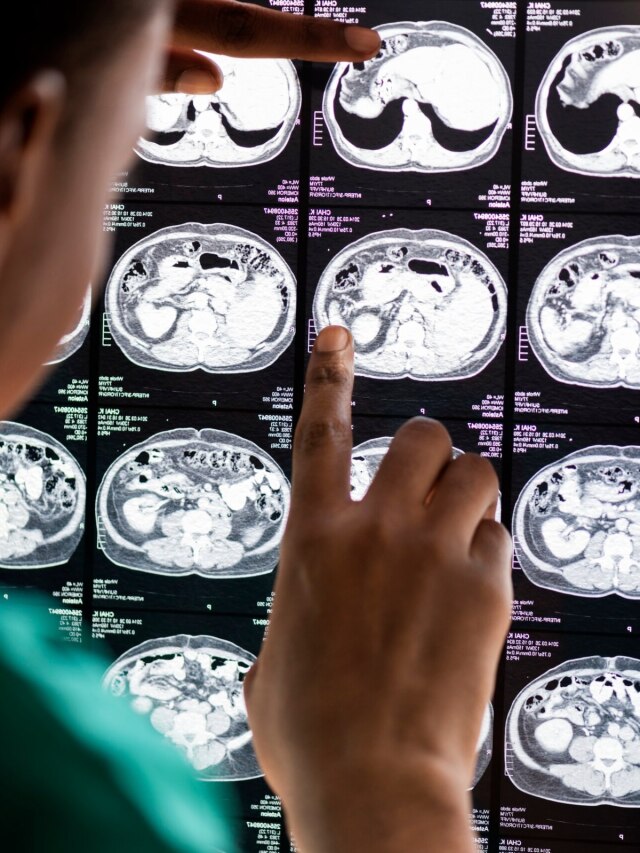 Can Viagra lower the risk of Alzheimer disease in men? Here is what the new study shows 