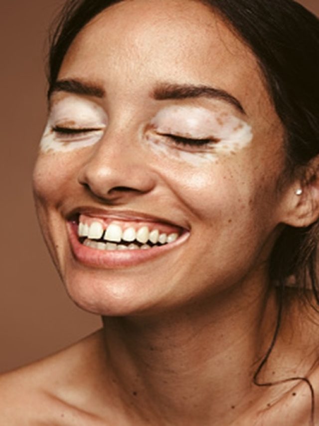 শ্বেতি রোগ থেকে মুক্তি খুঁজছেন? মেনে চলুন এসব নিয়ম