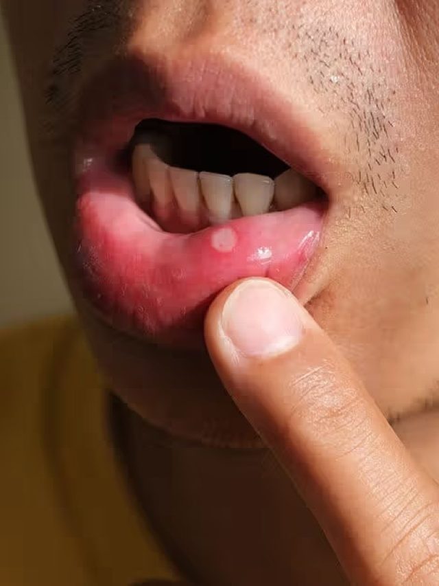 মুখে মাঝেমধ্যেই ঘা হচ্ছে? এই ঘরোয়া টোটকাতেই মিলবে চটজলদি সমাধান