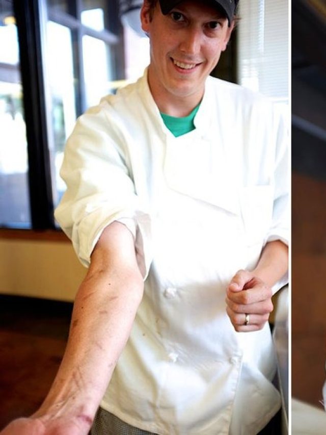 রান্না করতে গিয়ে হাত পুড়েছে, শুরুতেই কী করবেন?