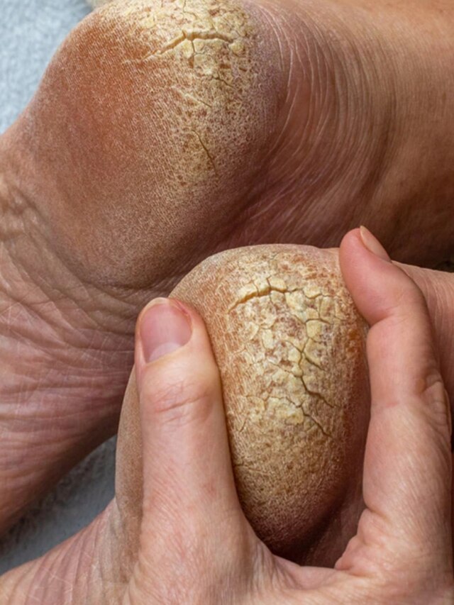 ফাটা গোড়ালি সারছে না? এই টোটকায় এক রাতেই হবে গায়েব