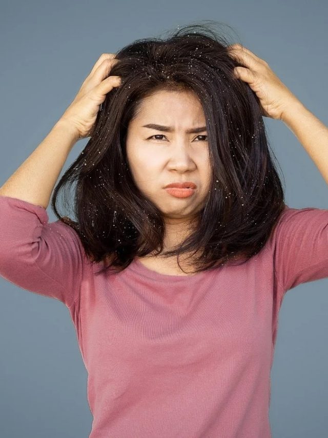 ১০ দিনেই নাছোড় খুশকি বলবে 'টাটা বাইবাই', জবরদস্ত টোটকা