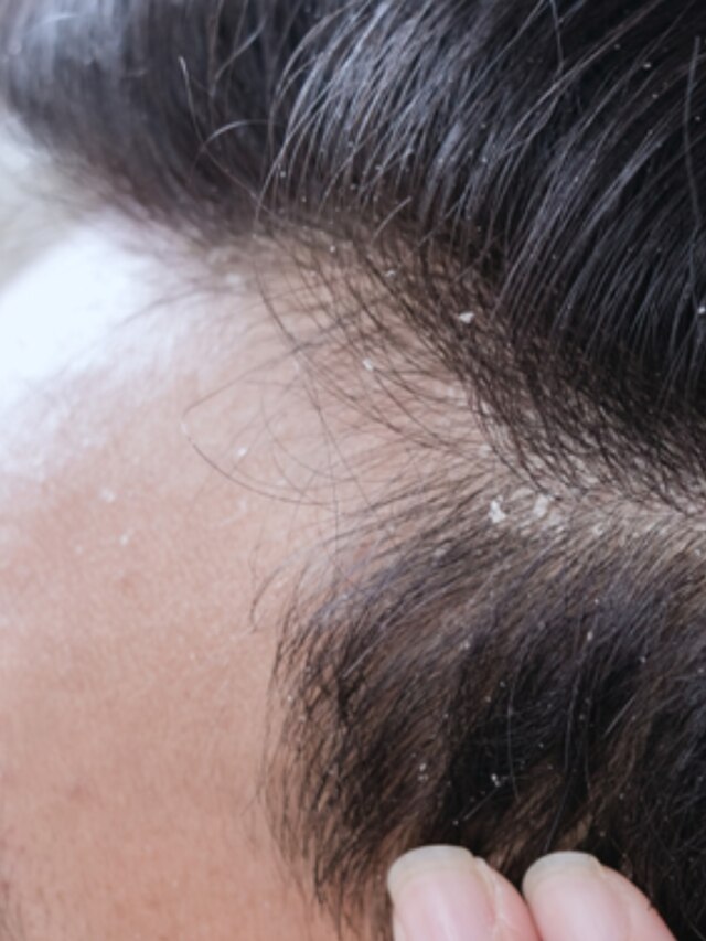 চুল হবে উজ্জ্বল,খুশকি-মাথার ময়লা ধুয়েমুছে সাফ ঘরের ৪ জিনিসে