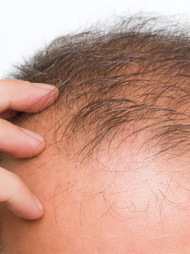 এই ৪ ভিটামিনের অভাবেই টাক মাথা, পাতে রাখুন এই সব খাবার