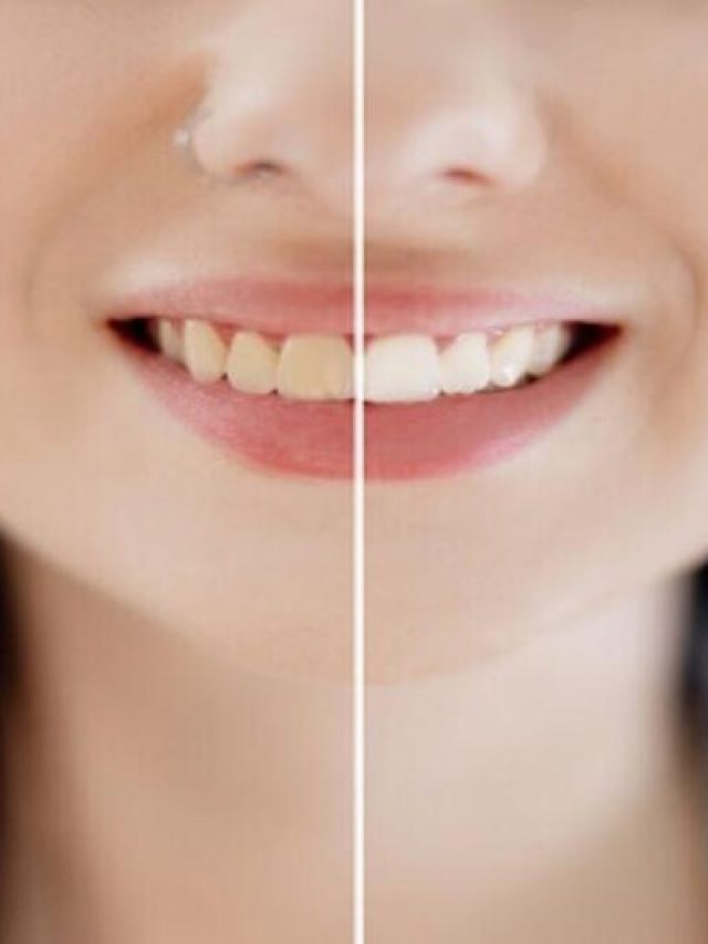 ১০ টাকার এই জিনিস দিয়ে ২ বার ব্রাশ, তাতেই দাঁতের হলদে ছোপ উঠবে