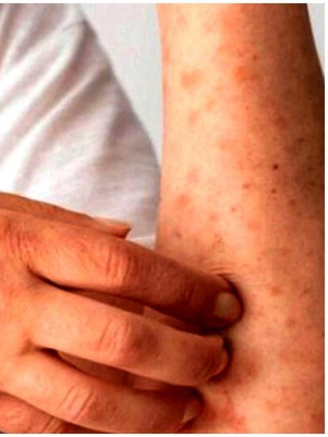 গরমে চুলকে চুলকে ঘামাচির দফারফা, না মেরেই সারিয়ে তুলুন এভাবে